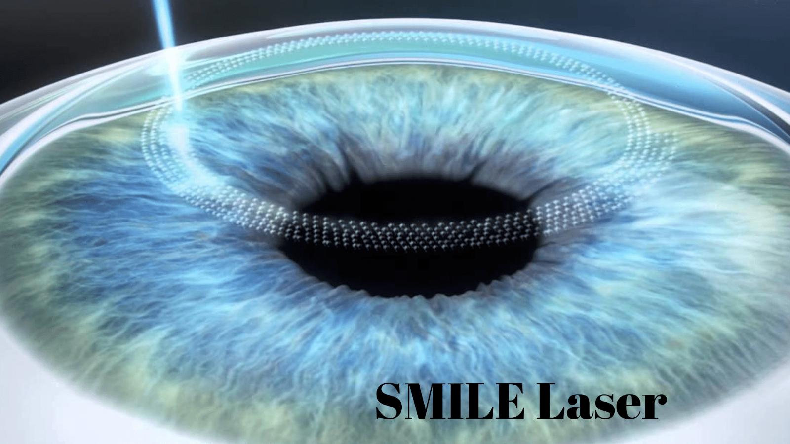 Difference Between LASIK and SMILE A Complete Guide Laser Eye